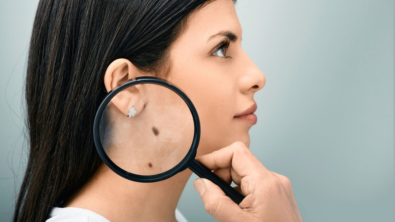 nega2 הסרת נגעי עור